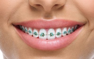¿Qué sucede con los tratamientos de ortodoncia durante el confinamiento?