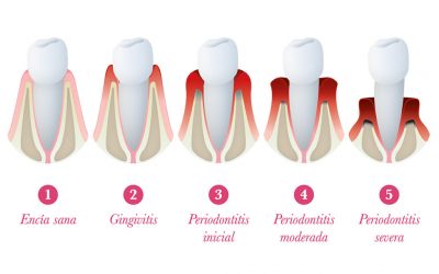 La periodontitis está relacionada con el cáncer