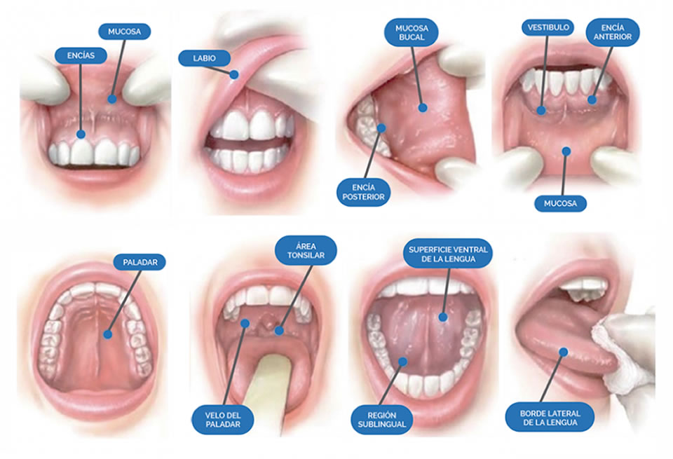 La autoexploración de la boca y la visita anual al dentista, medidas para prevenir el Cáncer Oral