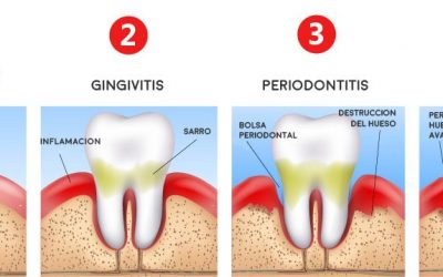 Los pacientes con periodontitis tienen casi 9 veces más posibilidades de fallecer si sufren COVID-19