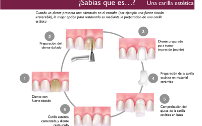 Las carillas dentales, solución clave en estética dental