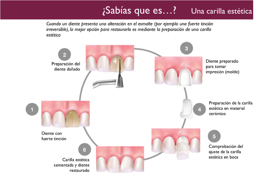 Las carillas dentales, solución clave en estética dental
